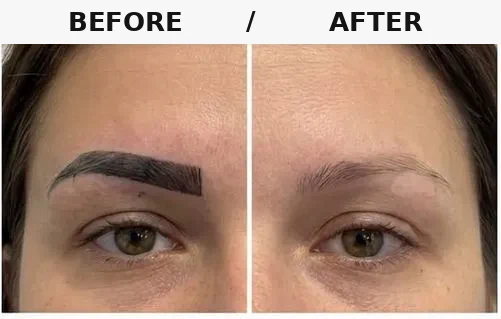 Before/after: too-dark, angular eyebrow microblading completely removed