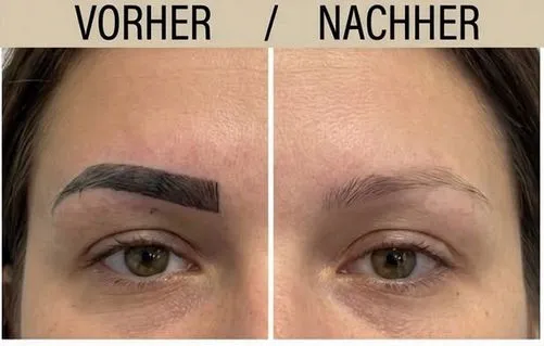Vorher-Nachher: zu dunkles, kantiges Microblading der Augenbrauen vollständig entfernt