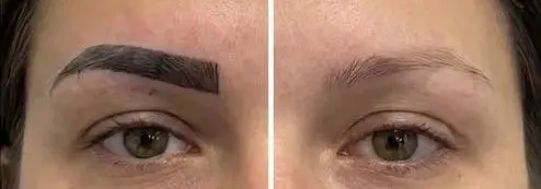 Detailansicht derselben Augenbrauen: links mit Microblading, rechts nach der Entfernung